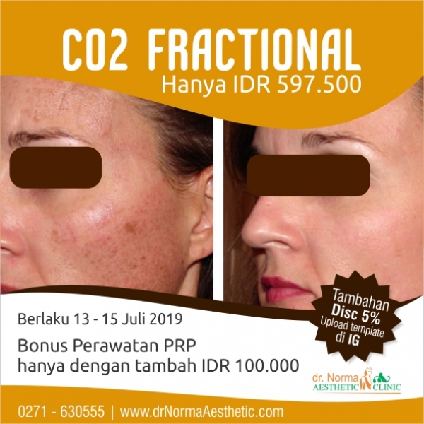 CO2 Fractional Promo